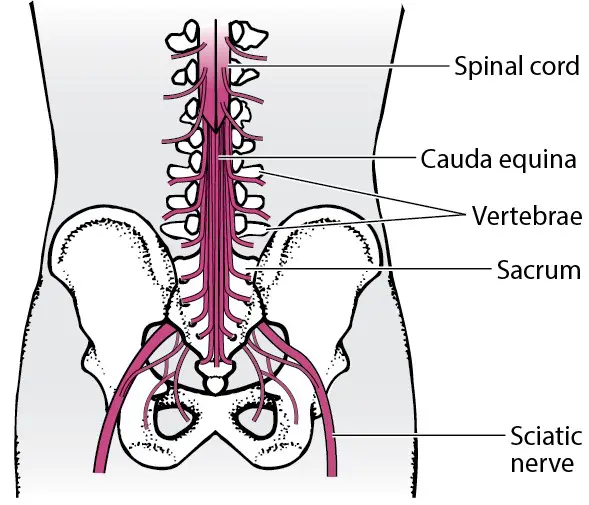 What Causes Sciatica Flare Triggers