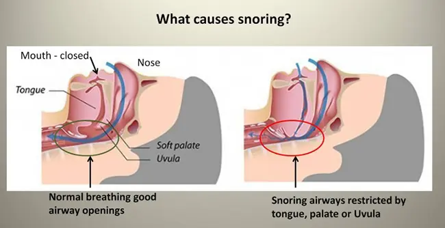 Sleep Apnea Snoring: Tell From Another?