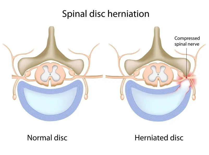 What Causes Sciatica Flare Triggers