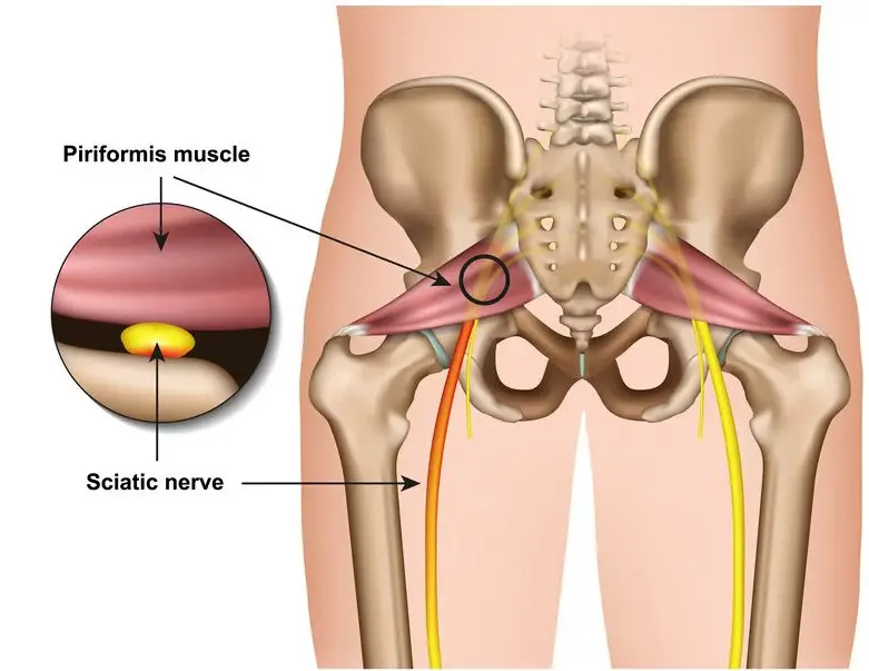 What Causes Sciatica Flare Triggers