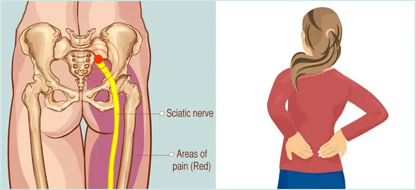 What Causes Sciatica Flare Triggers