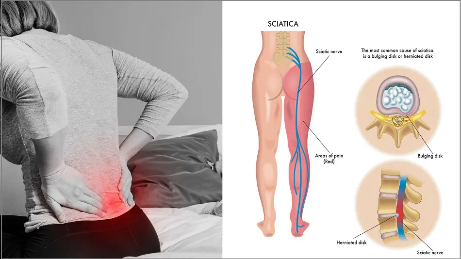 What Causes Sciatica Flare Triggers