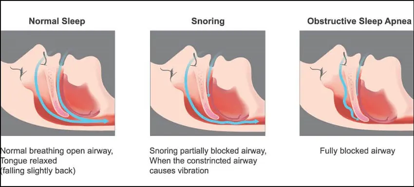 Sleep Apnea Snoring: Tell From Another?