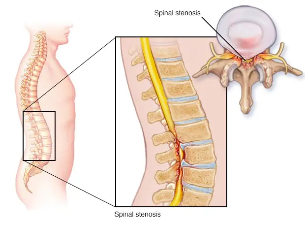 What Causes Sciatica Flare Triggers