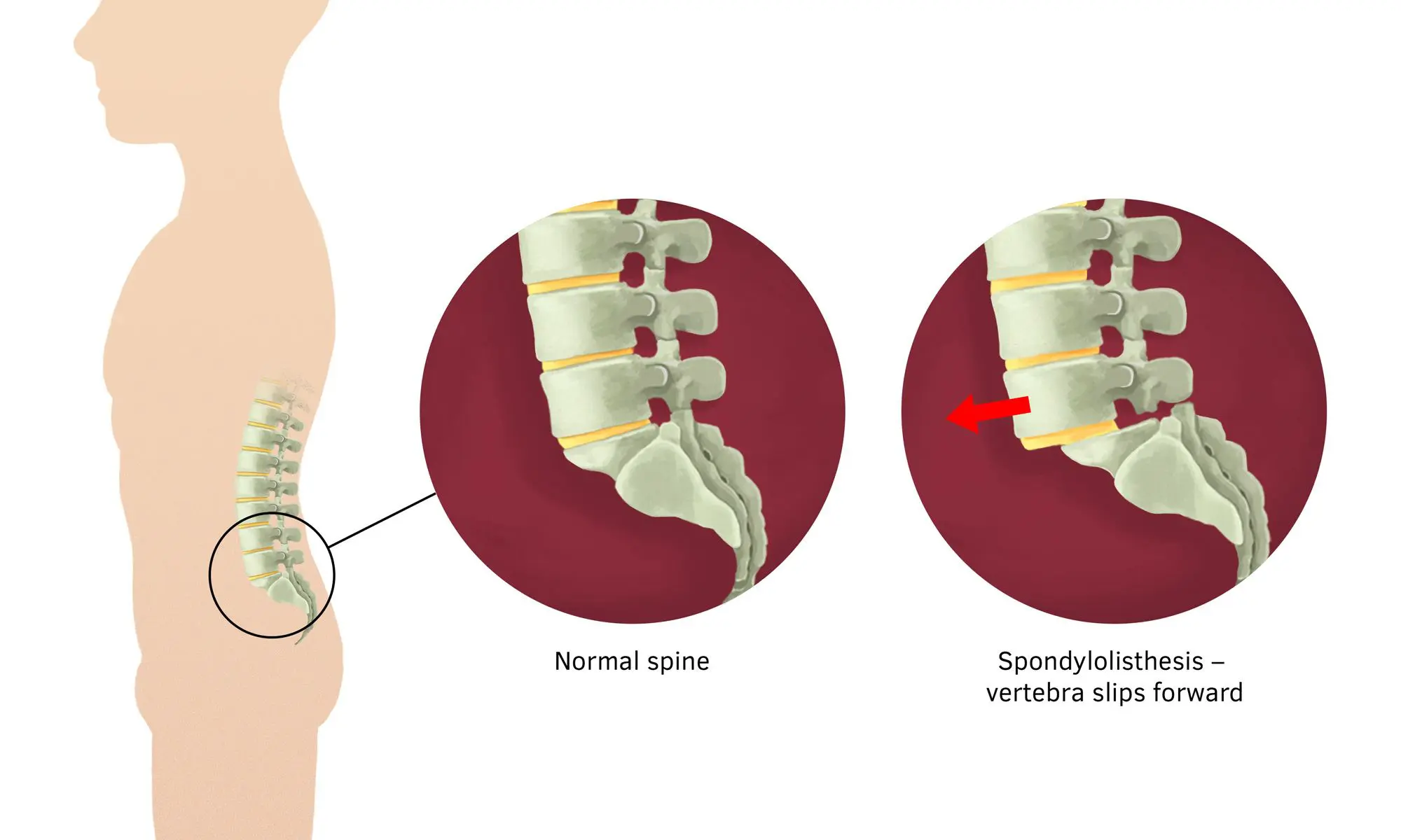 What Causes Sciatica Flare Triggers