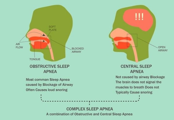 Sleep Apnea Vs Snoring How Do You Tell One From Another 33rd Square