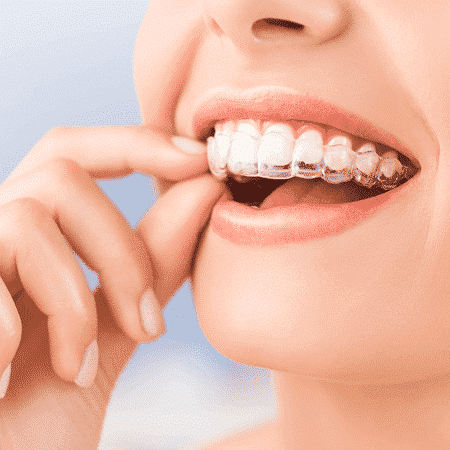 My In-Depth AlignerCo Review After Using Their Clear Aligners