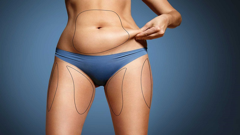 The Pros and Cons of Surgical Fat Removal